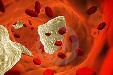 Атеросклероз диета при Атеросклероз - диета обязательна Атеросклероз - диета обязательна Атеросклероз диета при