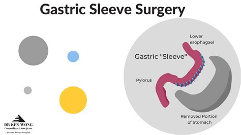 Gastric Bypass Vs Gastric Sleeve Your Options Explained 2022