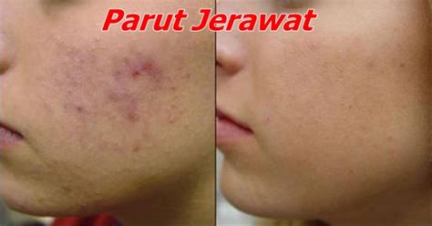 Parut hitam, parut berlubang kecil, parut berlubang besar macam kawah gunung berapi, ada juga parut jerawat jenis timbul macam keloid. 7 Cara Mudah Hilangkan Parut Jerawat Secara Semulajadi ...