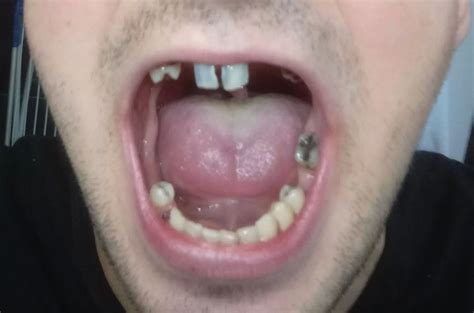 Nové Zuby V Co Nejkratší Době Hotovost Mám Zubní Implantáty Diskuze