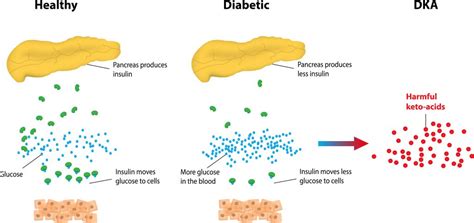 The Ketogenic Diet For Type 1 Diabetes Diet Plan