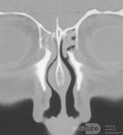 The Nasal Septal Swell Body • Image •