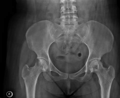Bilateral Avascular Necrosis Avn Of The Femoral Heads Radrounds