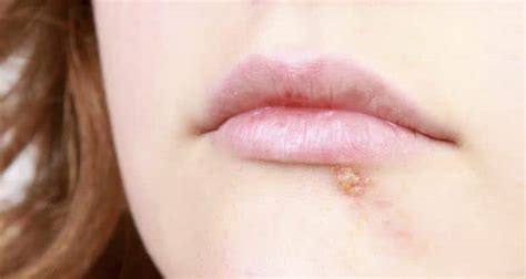 5 Signs And Symptoms Of Herpes You Should Know