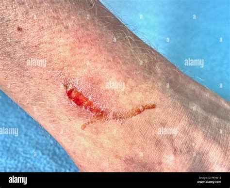 Skin Wound Wet Abrasion Deep Wound On The Skin In Detail Stock Photo