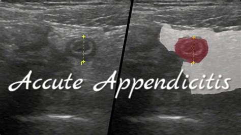 Acute Appendicitis Ultrasonography Youtube