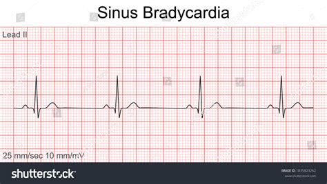 277 Sinus Bradycardia Images Stock Photos 3d Objects And Vectors