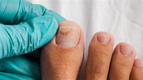 Why Are My Toenails Yellow Causes And Treatment Vlrengbr