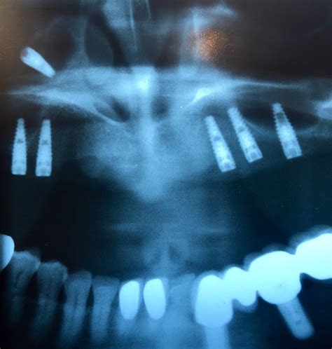 Dental Implant Discovered In Patients Sinus