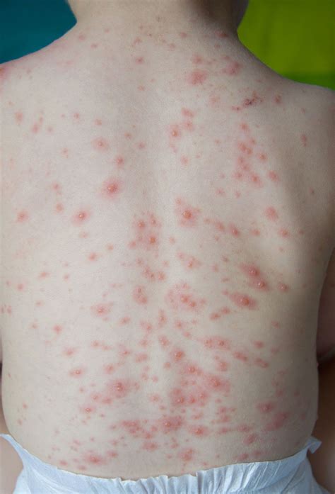 Chickenpox Description Cause Symptoms Britannica