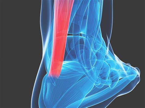 Achilles Tendon Pain What Is And How To Treat This Condition