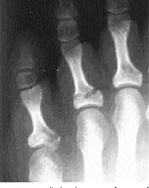 Figure 1 From Evaluation And Management Of Toe Fractures Semantic