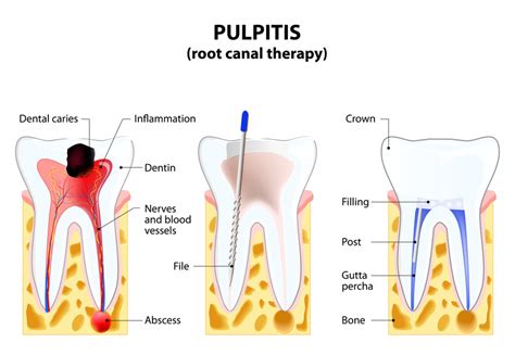 If you suspect you have a cavity, you should visit your local dentist. When a Cavity Needs a Root Canal - Smile Angels of Beverly ...