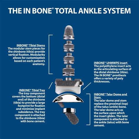 Ankle Replacement Surgery Florida Orthopaedic Institute