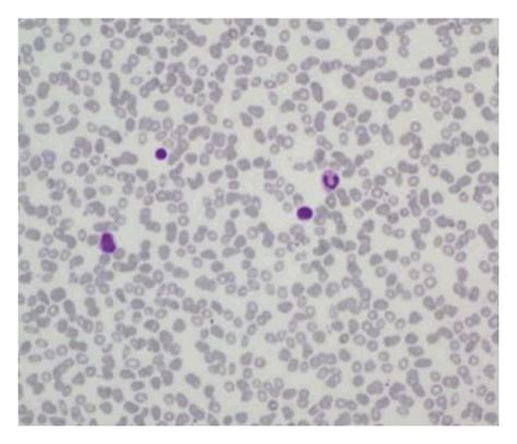 Peripheral Blood Smears Wright Giemsa Stained Showing Dimorphic