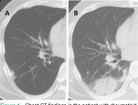 Figure 1 From Characteristics Of Pulmonary Cryptococcosis In Patients