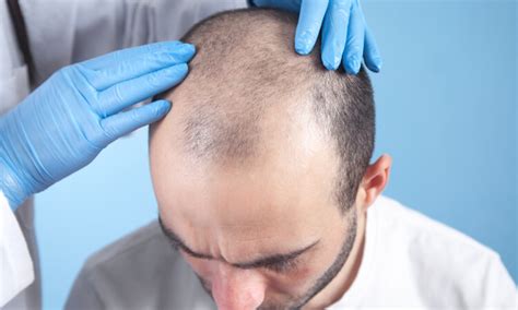 Failed Hair Transplant Can You Avoid Or Fix It Dr Emrah Cinik