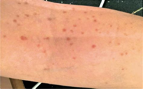Phytophotodermatitis Causes Symptoms Treatment And Healing Time
