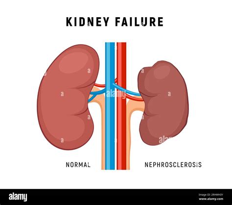 Kidney Failure Chronic Disease Urinary Renal Cancer Kidney Failure