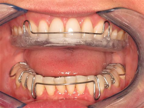 But you have to be careful because you really don't want it to come in the contact with the wounds. Orthodontist Dr. Judith A. Okun - Westchester and Rye ...