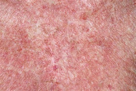 Exfoliative Dermatitis Images Symptoms And Pictures