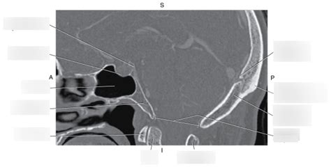 Sagittal Ct Of Occipital Bone Diagram Quizlet