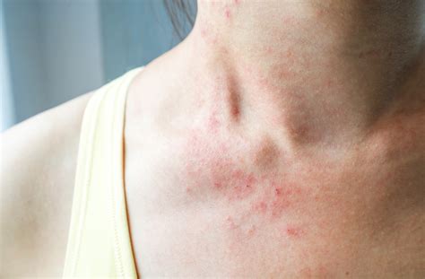 Atopic Dermatitis Chandigarh Ayurved And Panchakarma Centre