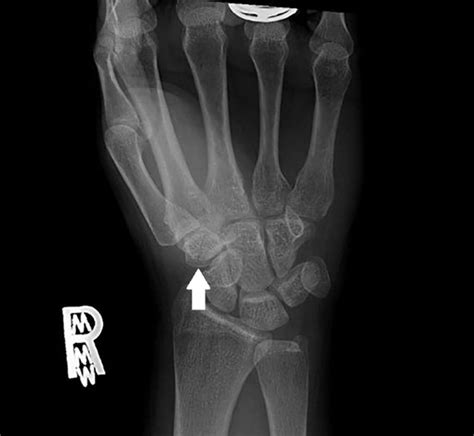 Approach to Isolated Trapezoid Fractures | Ochsner Journal