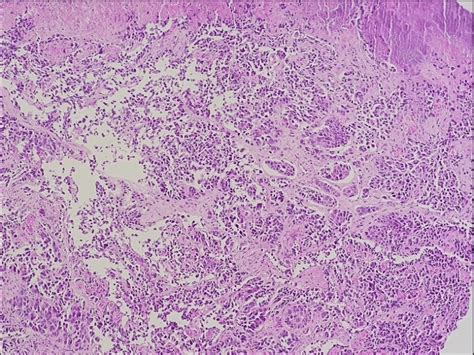 Wd Net Grade Nen Showing Nests Of Tumour Cells Underlying A