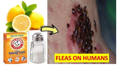 How To Get Rid Of Fleas On Humans