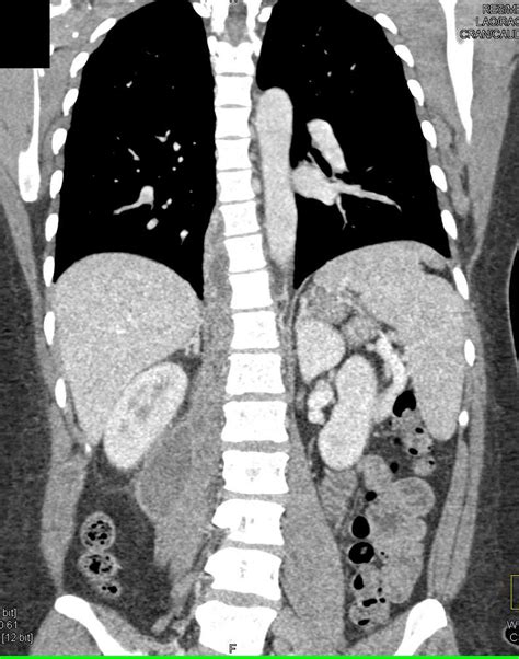Abscess Involving Psoas And Paraspinal Muscles Musculoskeletal Case