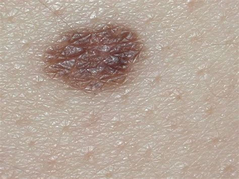 A B C D E Of Melanoma Learn How To Identify Melanoma At An Early Stage