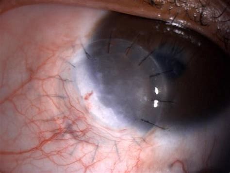 A Presence Of Left Eye Inferonasal Limbal Dermoid B Post Limbal
