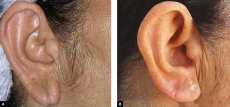 Rbcp Surgical Rejuvenating For The Aged Earlobe A Technical Innovation