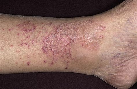 Eczema On Shin Pictures 81 Photos And Images