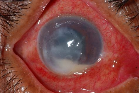 For example, with mild discomfort from a corneal scratch, artificial tear drops may be the only treatment. Steroids for keratitis? - EuroTimes