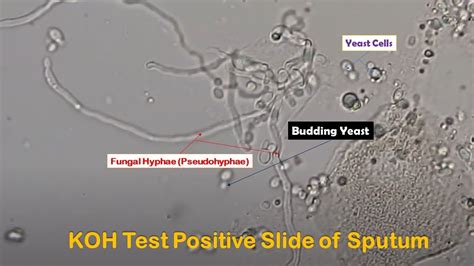 KOH Positive Showing Fungal Elements Yeast Cells Budding And Pseudohyphae In Sputum Sample