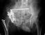 Pelvic Fracture Undergraduate Diagnostic Imaging Fundamentals