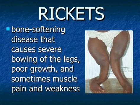 Common Diseasesdisorders Of The Skeletal System