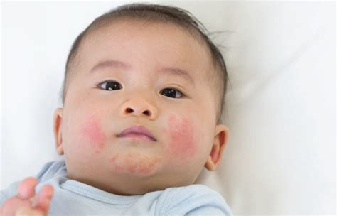 Eczema In Babies And Children Sbcc Baby And Child Clinic