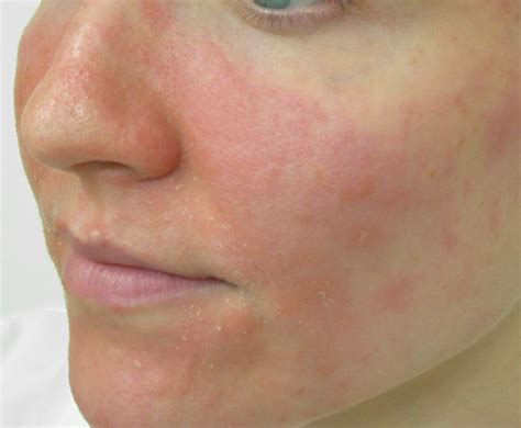 Facial Eczema Triggers And Dealing Methods New Health