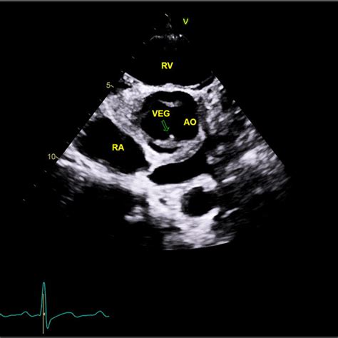 Transthoracic Echocardiography Parasternal Short Axis View Level Of
