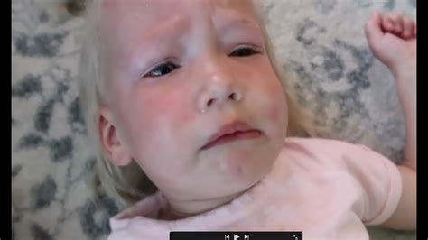 Baby Has Allergic Reaction Youtube