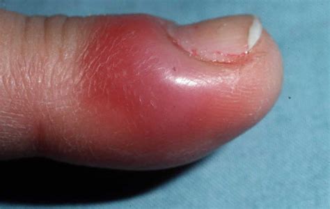 Acute And Chronic Paronychia Causes Prevention And Paronychia Treatment