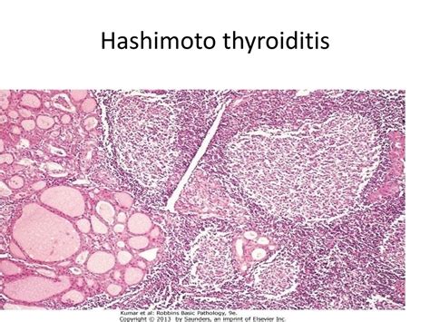 Ppt Thyroid Gland 1 And 2 Powerpoint Presentation Free Download Id