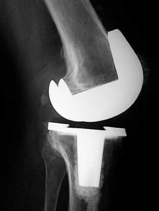 Stiffness After Total Knee Replacement Musculoskeletal Key