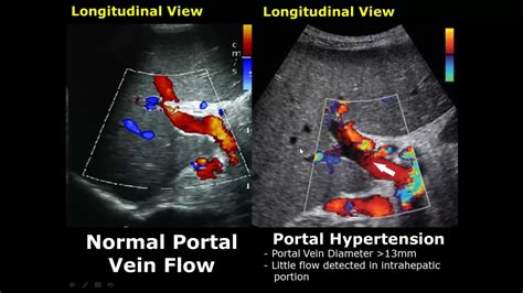 Liver Ultrasound Normal Vs Abnormal Image Appearances Comparison Liver Pathologies Usg Youtube