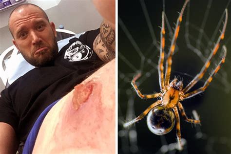 False Black Widow Spider Horrific Bite Leaves Inch Deep Weeping Hole In His Leg Daily Star