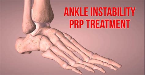 Treating Ankle Pain With Prp Chicago Arthritis And Regenerative Medicine