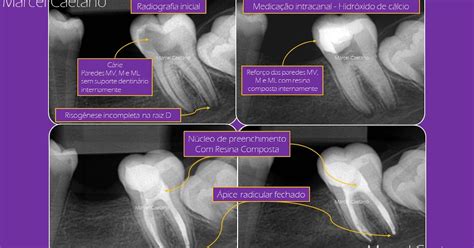 Endodontia Avançada Tratamento endodôntico de dente com risogênese incompleta indução do